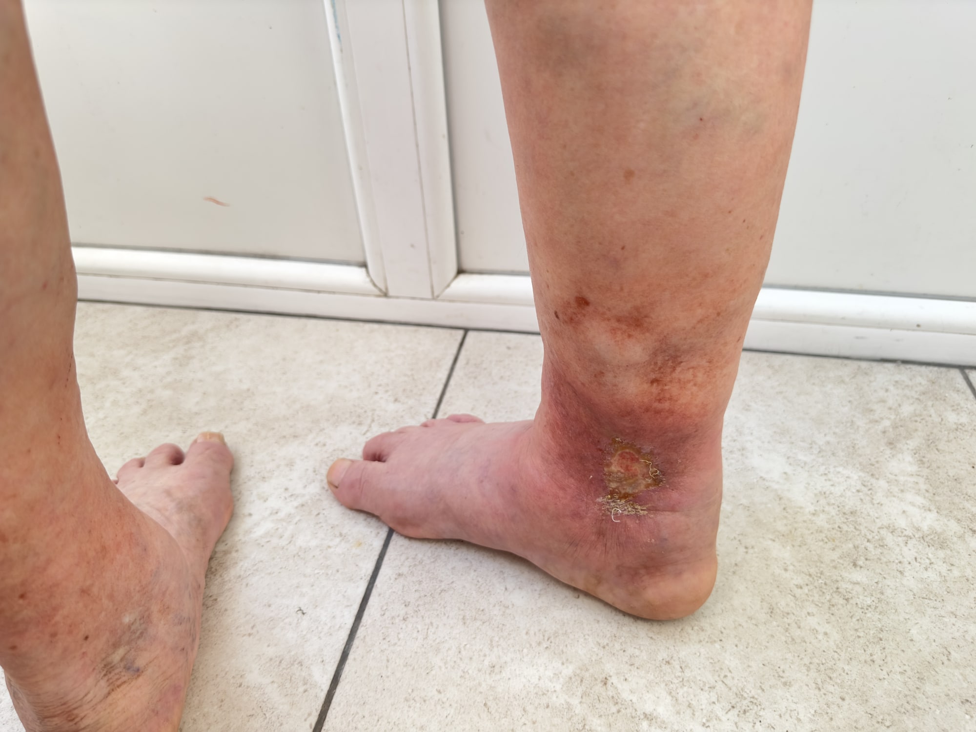 Oedema Leg Ulcers